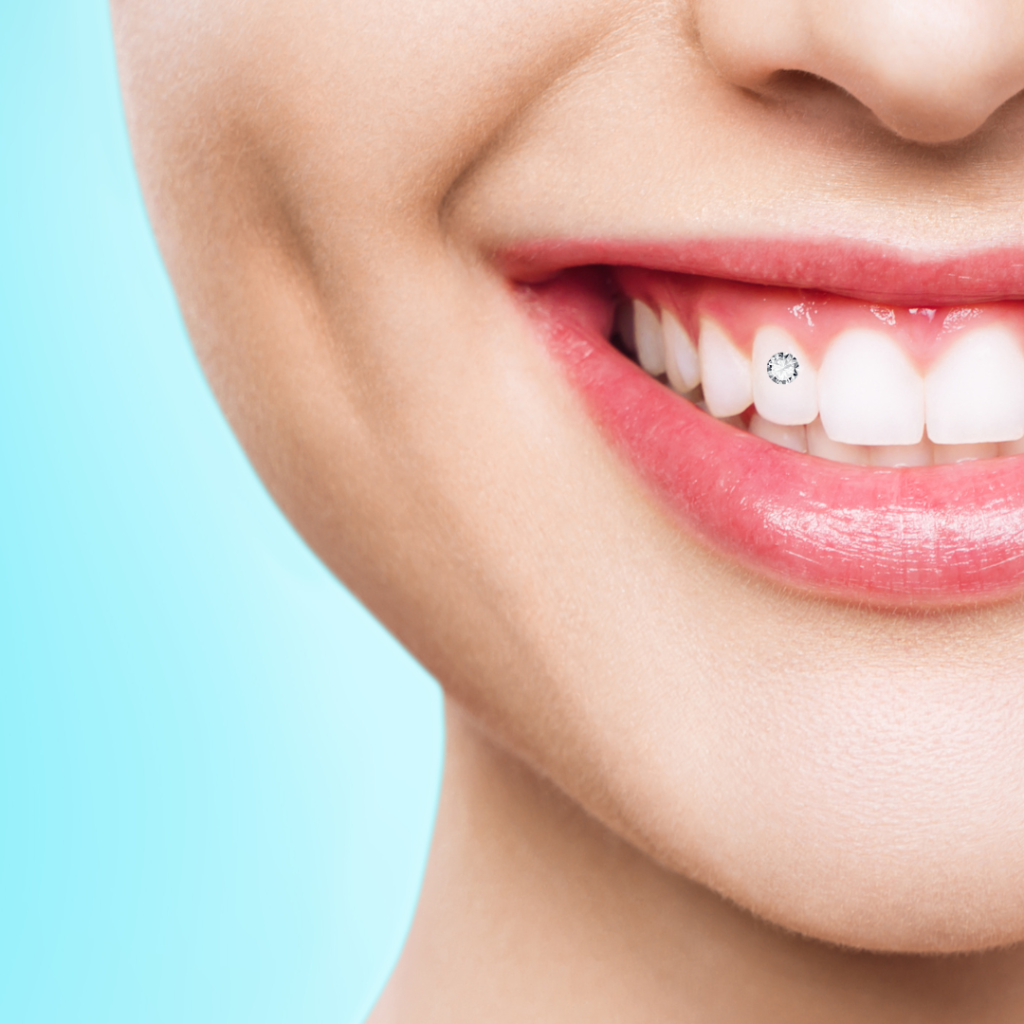 hambakaunistuse paigaldamine kristall hambale viimsi hambakliinik