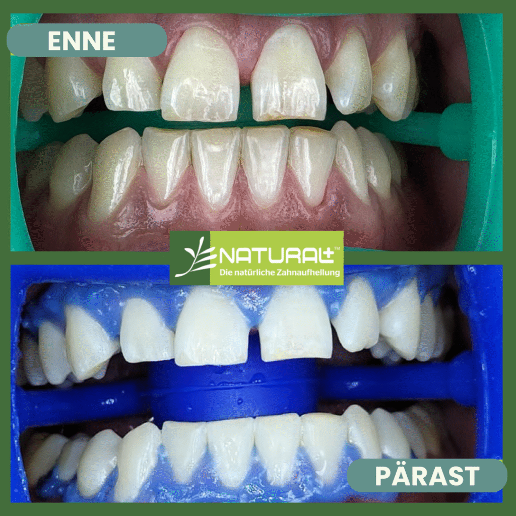 Natural+ hammaste valgendamine enne ja pärast