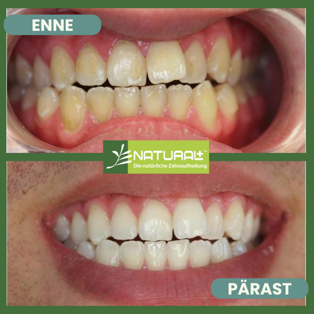 Natural + hammaste kabineti valgendus enne ja pärast