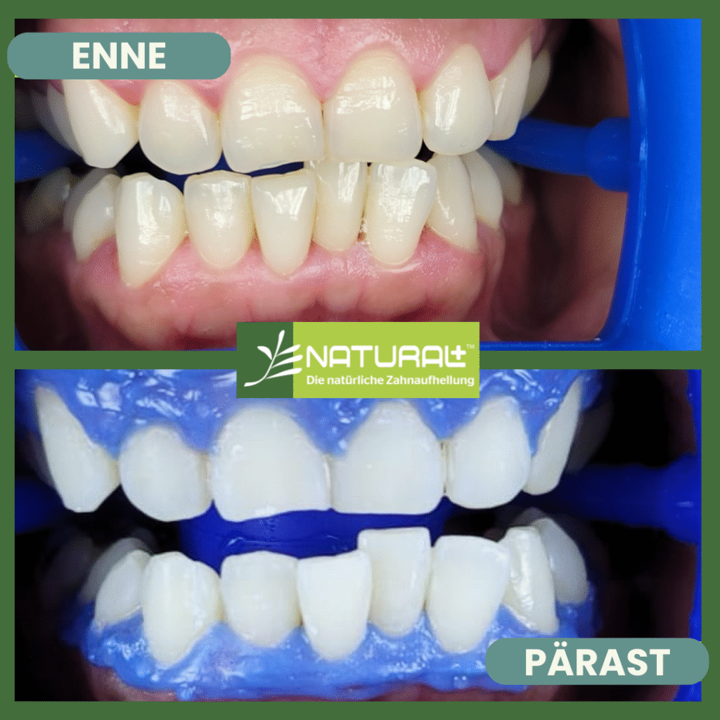Natural+ hammaste valgendamine enne ja pärast
